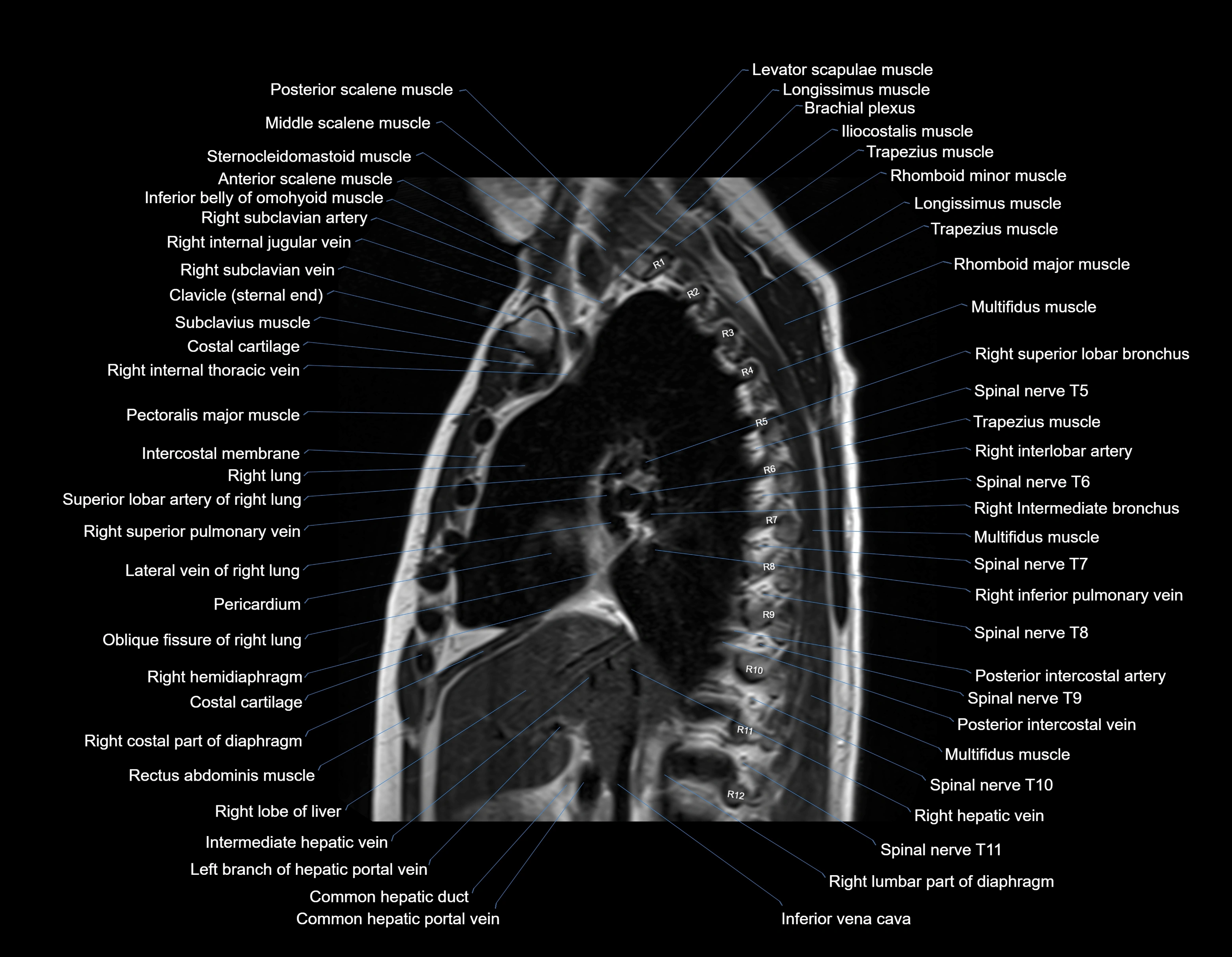 MRI chest (thorax) sagittal labelled cross sectional anatomy 3T radiology image-img-00001-00016.webp